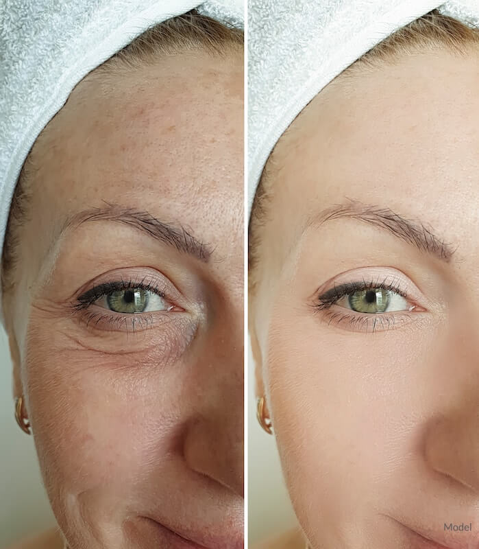 Side-by-side image of a woman with and without bags beneath her eyes.