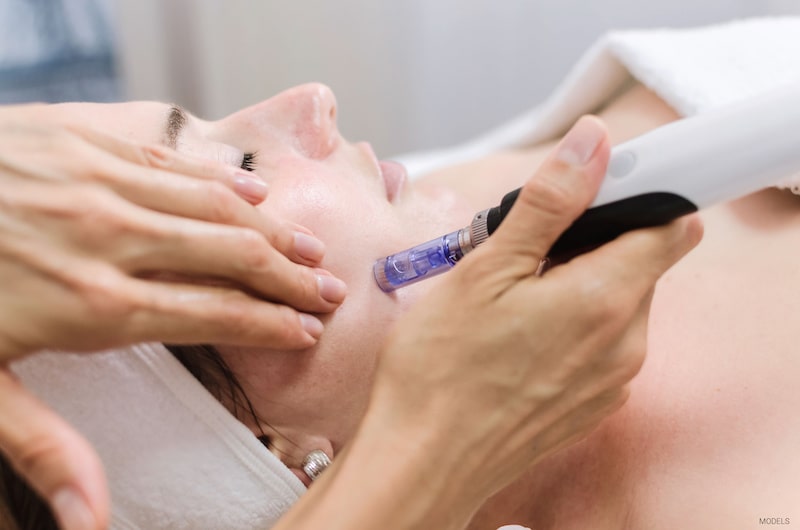 Woman getting microneedling on face