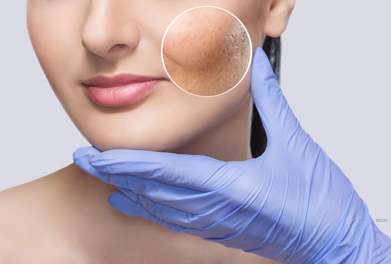 Doctor holding a woman's face and showing how resurfacing has improved the quality of her skin.