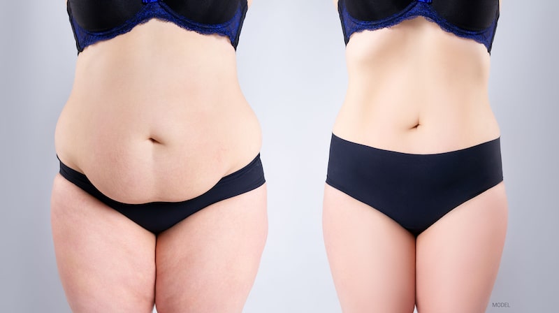 Image of a woman wearing black underwear, before and after liposuction